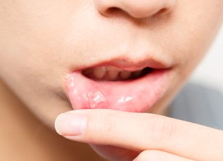 Pourquoi a-t-on des aphtes ? femme avec un aphte